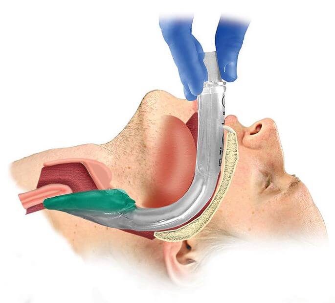 TCCC Airway management