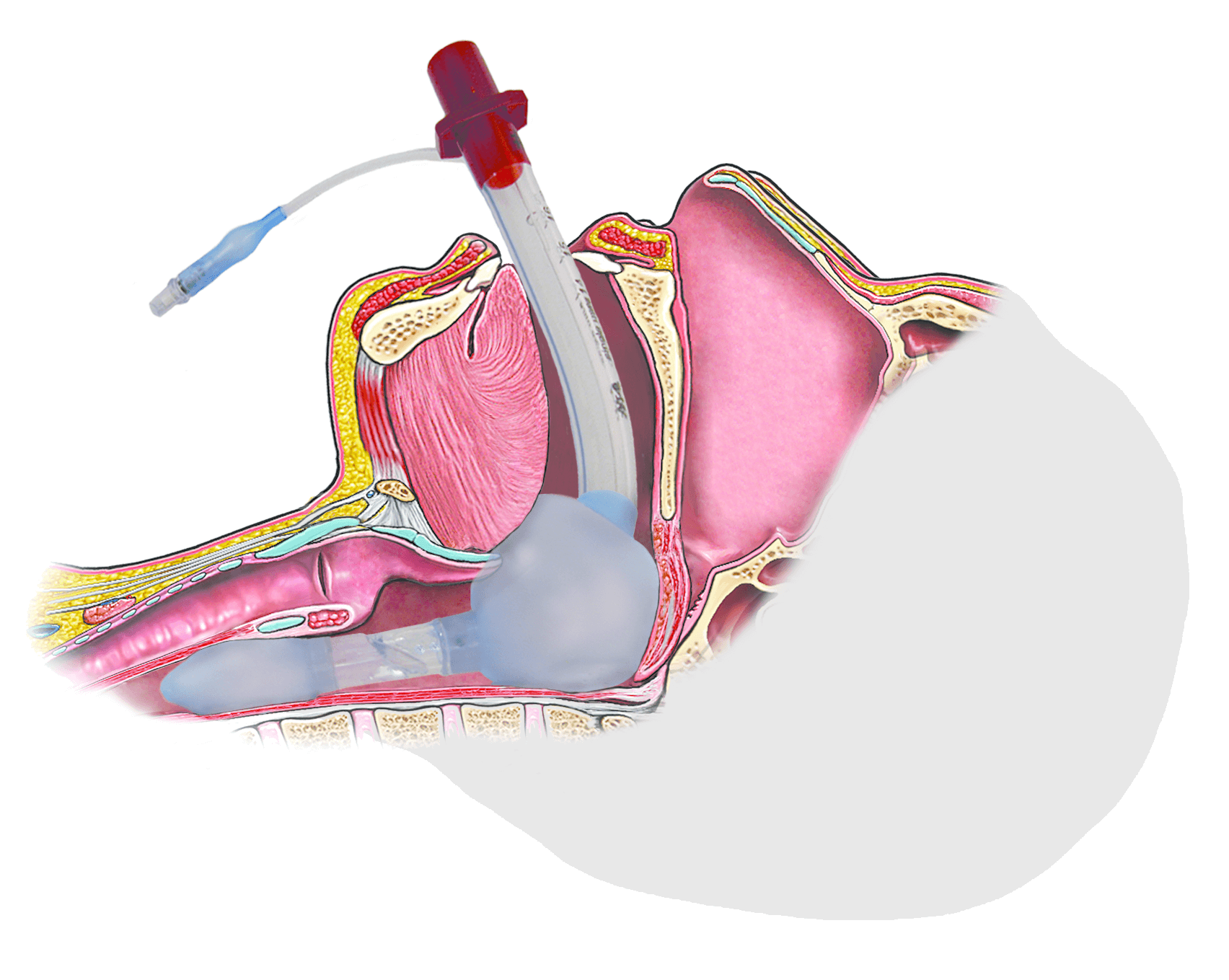 TCCC Airway management